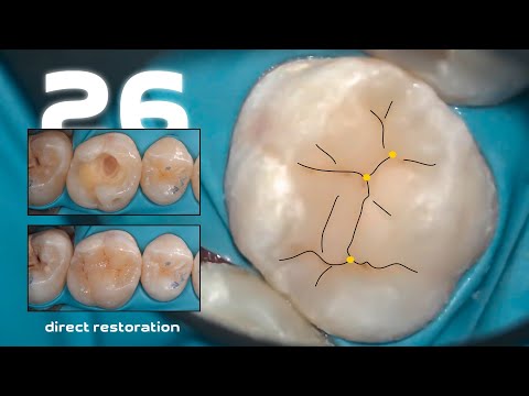Видео: Композитная реставрация 26 зуба (от препарирования до полировки)
