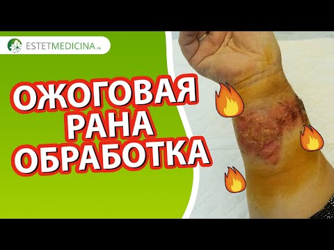 Видео: КАК ЛЕЧИТЬ ОЖОГ🔥: первая помощь + как обрабатывать ожоговую рану 🔥ПОДПИШИСЬ НА КАНАЛ, ПОДДЕРЖИ НАС!
