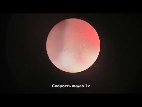 Видео: Удаление камня верхней трети мочеточника. Контактная уретеролитотрипсия. Случай #3