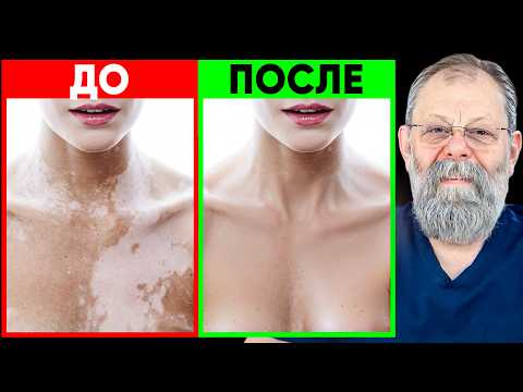 Видео: Витилиго. Всё про витилиго! Как избавиться от витилиго?
