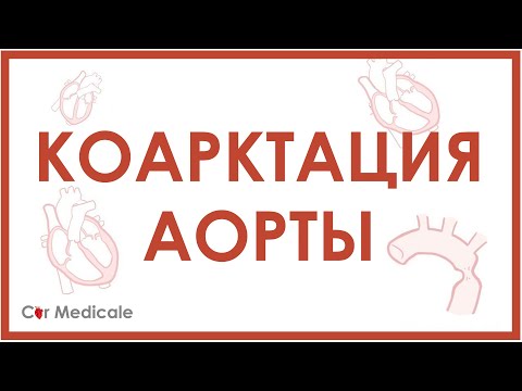 Видео: Коарктация аорты