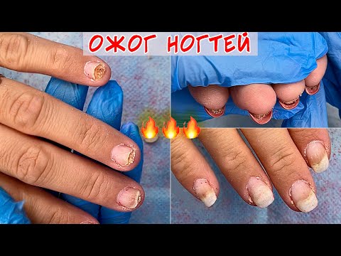 Видео: Ожог ногтевой пластины / Зачистка ногтя