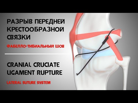 Видео: Разрыв передней крестообразной связки. Фабелло-тибиальный шов. Lateral Suture System 3D