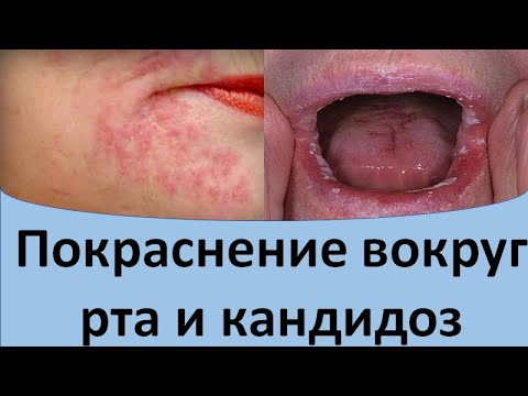 Видео: Покраснение вокруг рта и кандидоз