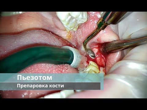 Видео: Удаление зачатка ретенированного зуба мудрости