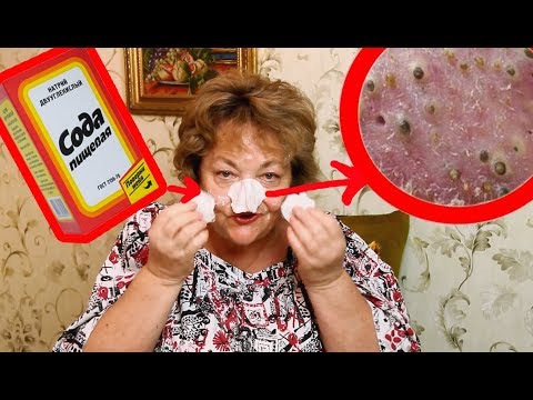 Видео: Как убрать черные точки на носу содой