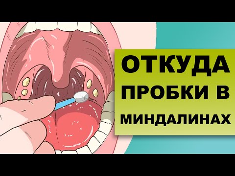 Видео: КАК УХОДЯТ ПРОБКИ ИЗ МИНДАЛИН