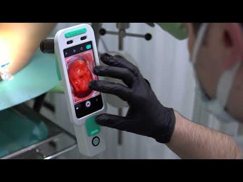 Видео: Кольпоскопия шейки матки