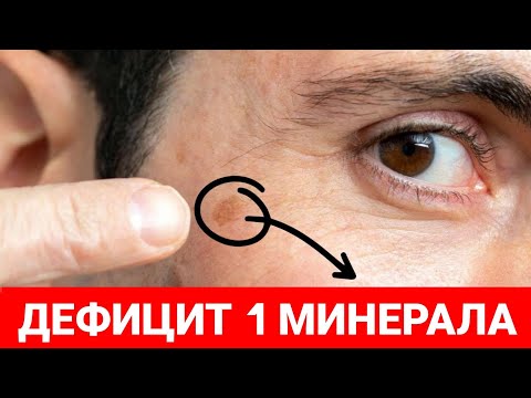 Видео: В ЭТОМ КРОЕТСЯ ПРИЧИНА ПИГМЕНТНЫХ ПЯТЕН НА РУКАХ!