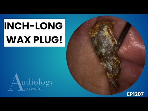 Видео: Подборка экстремального удаления ушной серы | 5 глубоких чисток ушей с аудиологами! - EP1207