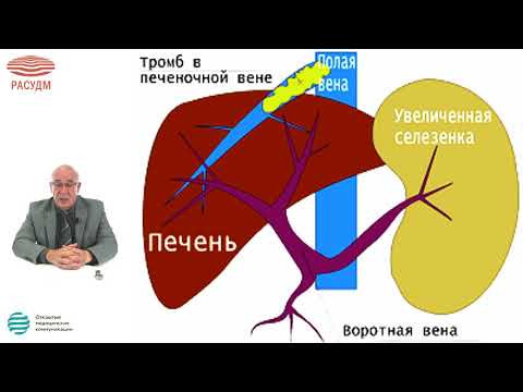 Видео: Ультразвуковая диагностика портальной гипертензии у детей