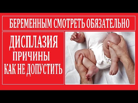 Видео: Дисплазия тазобедренного сустава - Причины, Как Избежать. Беременным Смотреть Обязательно!