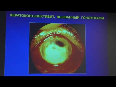 Видео: Бактериальные кератоконъюнктивиты часть 1