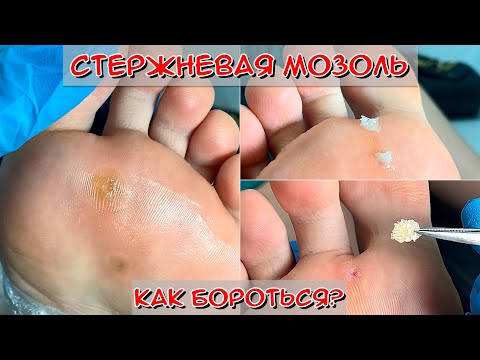 Видео: Стержневая мозоль на стопе 🦶 / Почему появляются мозоли?