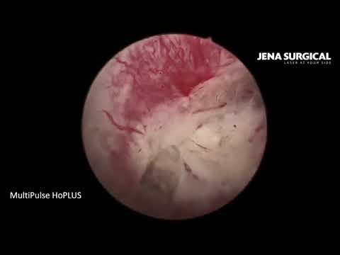 Видео: Гольмиевая энуклеация аденомы простаты (HoLEP).Техника En-bloc. Литотрипсия камней МП.