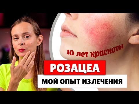 Видео: РОЗАЦЕА НЕ ПРИГОВОР: Как я избавилась от пятен на лице после 10 лет мучений!