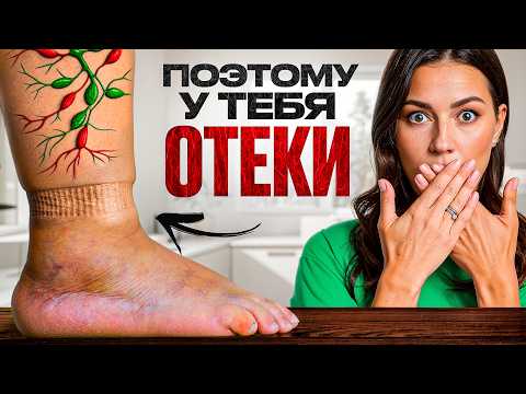 Видео: ОТЕКИ = сигнал SOS! Что скрывает ваш организм?