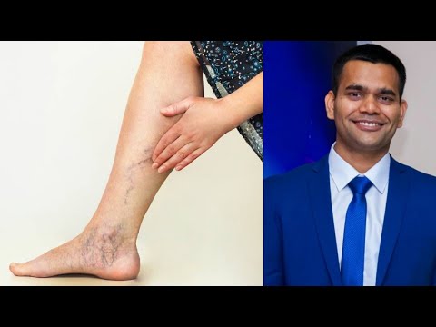 Видео: Варикоз вен на ногах- Лечение | Как лечить варикозное расширение вен