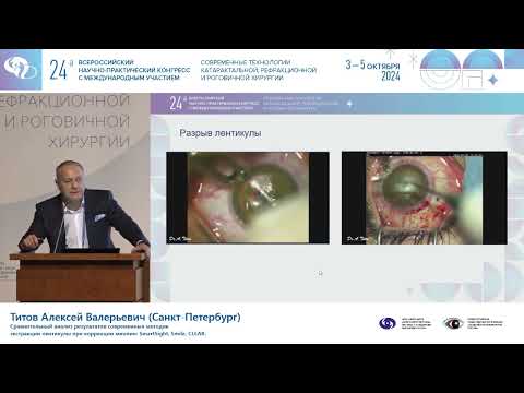 Видео: Анализ результатов методик экстракции лентикулы при коррекции миопии: SmartSight, Smile, CLEAR