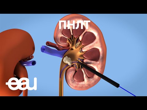 Видео: Перкутанная нефролитотомия - ПНЛТ (EAU - PCNL RU)