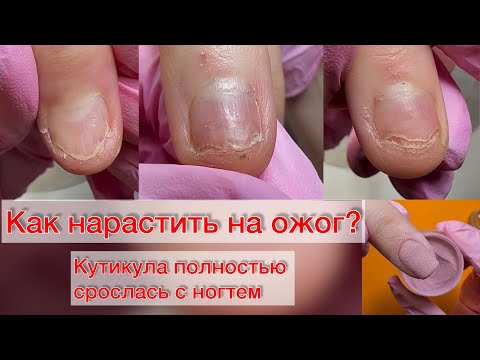 Видео: КАК НАРАСТИТЬ НА ОЖОГ? НОГТИ ПОСЛЕ ОЖОГА ЧЕМ МОЖНО ПОКРЫВАТЬ? Дип система. Титановые ногти