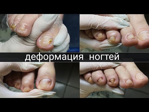 Видео: Утолщение ногтей и онихолизис из-за деформации пальцев ног. Зачистка онихолизиса и педикюр пальцев
