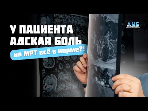 Видео: Когда у пациента АДСКАЯ боль, а на МРТ НОРМА и наоборот: клинико-рентгенологическая диссоциация