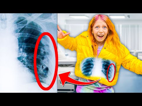 Видео: МИЛАНА СЛОМАЛА РЕБРО??! УТРО В БОЛЬНИЦЕ! ЧТО СЛУЧИЛОСЬ???