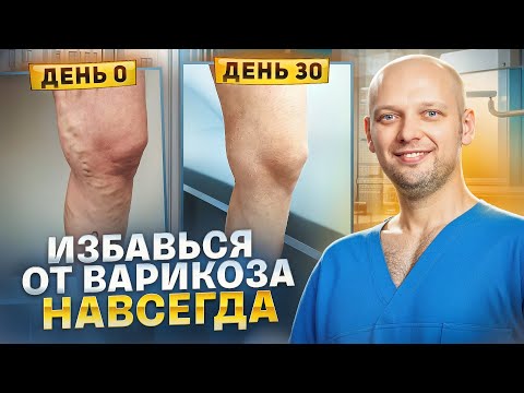 Видео: НЕ ЛЕЧИ ВАРИКОЗ ПОКА НЕ ПОСМОТРИШЬ ЭТО ВИДЕО | ФЛЕБОЛОГ О ВАРИКОЗЕ