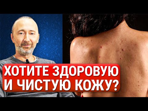 Видео: Как РЕАЛЬНО избавиться от прыщей, акне и угрей? ЭТИ малоизвестные способы помогут в 99% случаев!