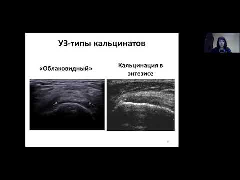 Видео: Кальцифицирующий тендинит плечевого сустава УЗИ