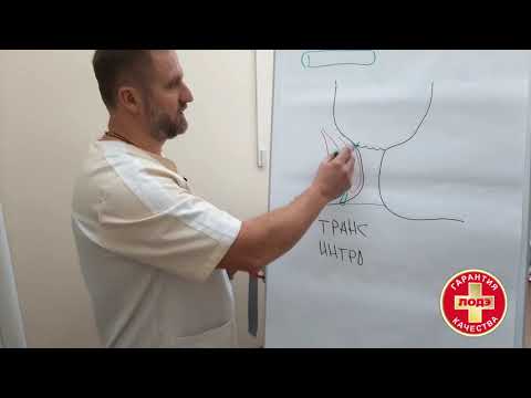 Видео: Свищи прямой кишки