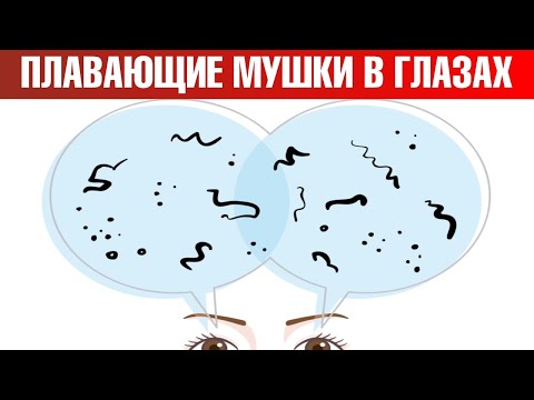 Видео: Как избавиться от мушек в глазах? Мушки перед глазами: причины🧐