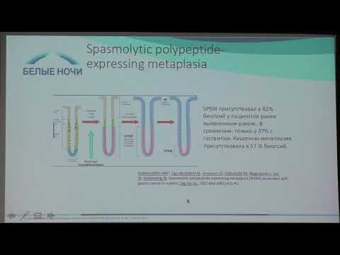 Видео: 04 Ткаченко ОБ Как не пропустить опухоль желудка