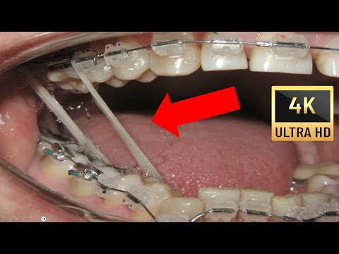 Видео: Кръстосана (букална) захапка при възрастни - 10 години след лечението❗