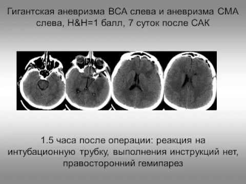 Видео: САК и инсульт, интенсивная терапия и нейропротекция (2 МСН) Савин И.А.