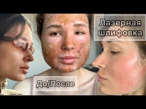 Видео: Лазерная шлифовка лица лазером CO2 | Весь процесс реабилитации | До и После | Стоило ли оно того?!