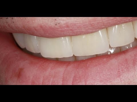 Видео: Реставрация сразу всех зубов по новой технологии