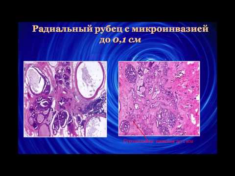 Видео: Рак молочной железы Анурова О.А.