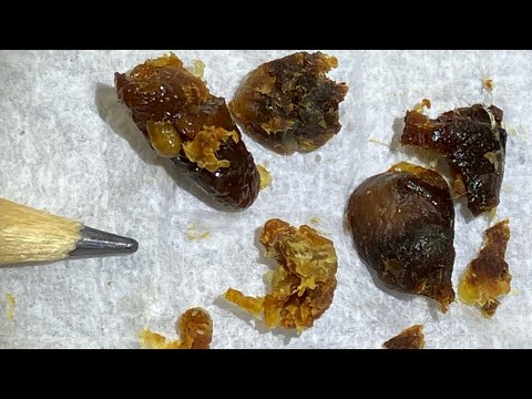 Видео: 32 - Удаление очень стойкой ушной серы с помощью WAXscope®️