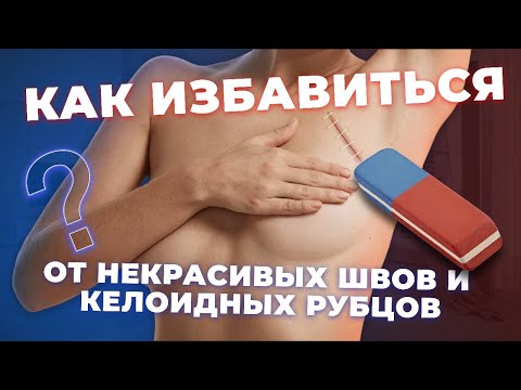 Видео: Келоидный рубец и методы исправления некрасивых швов