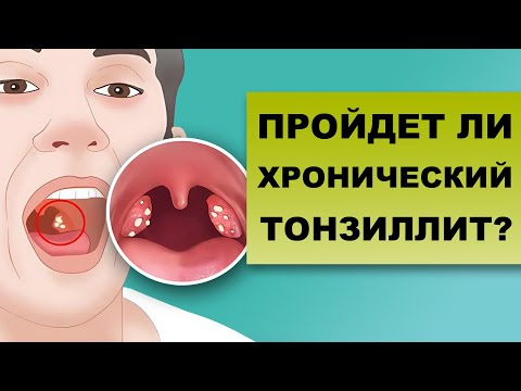 Видео: МОЖЕТ ЛИ ХРОНИЧЕСКИЙ ТОНЗИЛЛИТ ПРОЙТИ САМ?