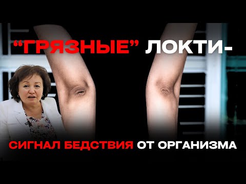 Видео: "ГРЯЗНЫЕ" ЛОКТИ - СИГНАЛ БЕДСТВИЯ ОТ ОРГАНИЗМА