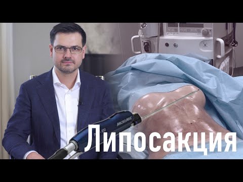 Видео: Липосакция // Важные вопросы