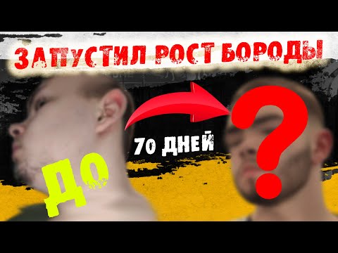 Видео: Как я стал отращивать бороду. Мажу Капиксил М 70 дней. Андрей Борода Выпуск №31