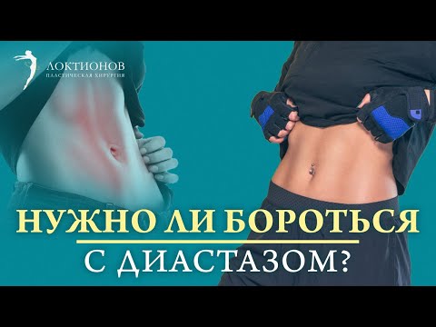 Видео: А вы знаете, чем опасен диастаз? Помогут ли физические упражнения от диастаза? Как убрать диастаз