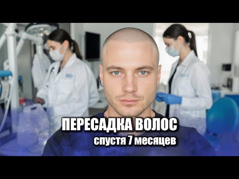 Видео: Пересадка волос спустя 7 месяцев / Клиника GG Med / Трихолог