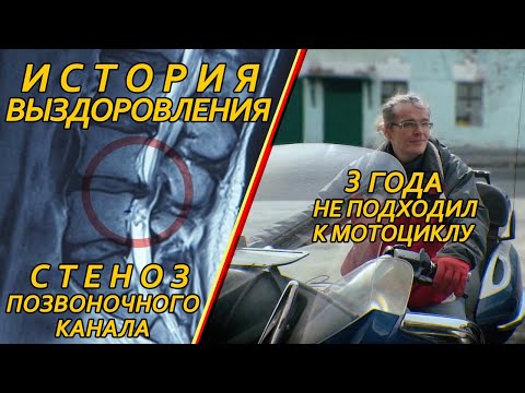 Видео: Стеноз позвоночного канала. МРТ до и после. История выздоровления.