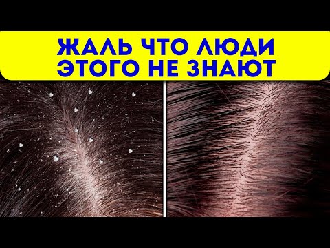 Видео: Если заметили у себя перхоть, знайте, что тело предупреждает о...