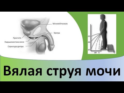 Видео: Вялая струя мочи